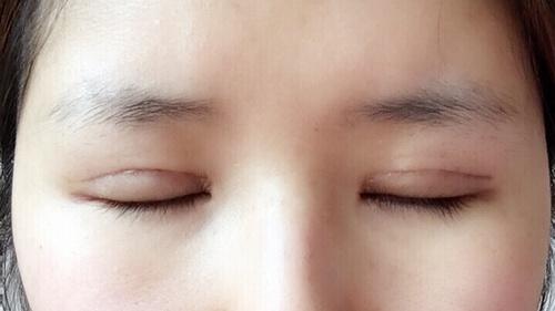 雙眼皮,注意事項(xiàng)
