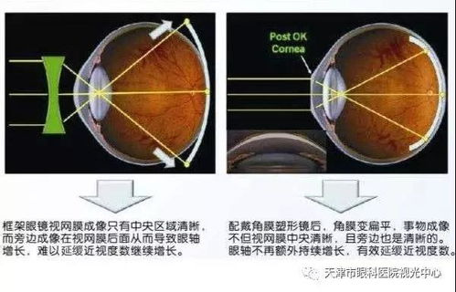 佩戴角膜塑形鏡的注意事項,角膜塑形鏡注意事項,戴角膜塑形鏡注意事項