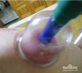 風濕,注意事項,治療,拔罐