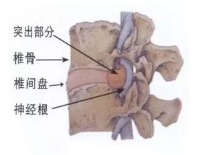 注意事項(xiàng),患者,腰椎間盤(pán)突出