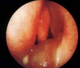 息肉,喉嚨,注意事項(xiàng)