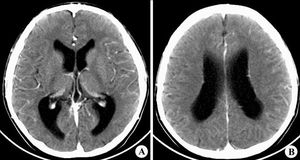 腦水腫飲食的注意事項,腦水腫脫水治療時的注意事項是,腦水腫期注意事項