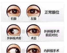 小兒斜視手術(shù)后注意事項(xiàng),斜視矯正術(shù)后注意事項(xiàng),間歇性斜視術(shù)后注意事項(xiàng)