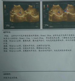 肝臟,注意事項(xiàng),彩超