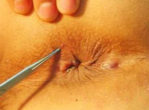 做肛瘺手術(shù)前注意事項