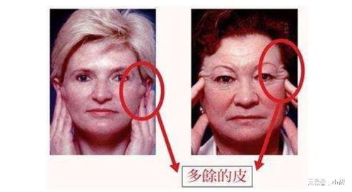 拉皮手術(shù)術(shù)后注意事項