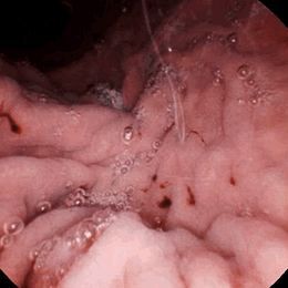 糜爛性胃炎注意事項,胃炎注意事項及飲食禁忌,反流性胃炎注意事項