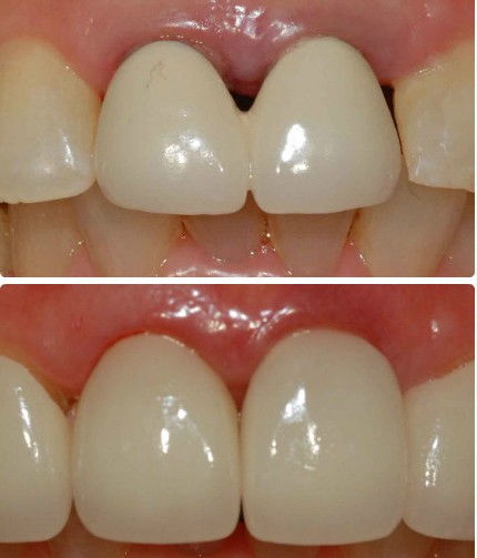 修復(fù),注意事項(xiàng),烤瓷牙