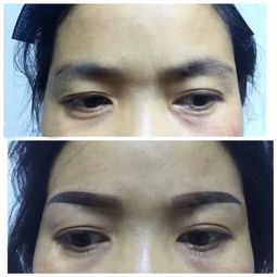 術(shù)后,注意事項(xiàng)