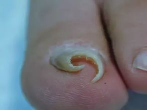 修治嵌甲的注意事項(xiàng)