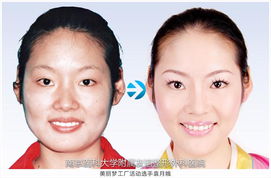 嘴巴整容注意事項(xiàng)