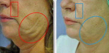 針灸埋線后的注意事項,埋線減肥后注意事項,埋線后注意事項有哪些