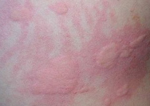 注意事項(xiàng),兒童,尋麻疹