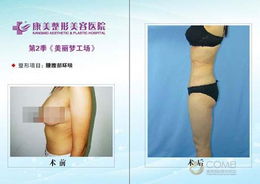 腰腹吸脂術(shù)后注意事項(xiàng)細(xì)節(jié),腹部吸脂術(shù)后注意事項(xiàng),面部吸脂術(shù)后注意事項(xiàng)