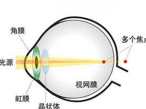 佩戴散光眼鏡注意事項,兒童散光注意事項,散光注意事項及飲食