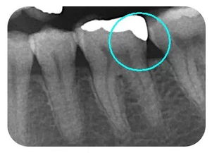 戴完嵌體后的注意事項