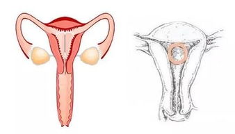 去節(jié)育環(huán)后的注意事項