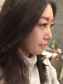 果酸,嫩膚,注意事項