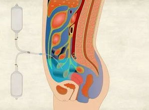 可人腹膜注意事項(xiàng)