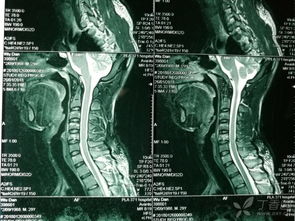 頸椎骨折翻身注意事項(xiàng),頸椎骨折牽引翻身注意事項(xiàng),頸椎骨折病人翻身時(shí)注意事項(xiàng)