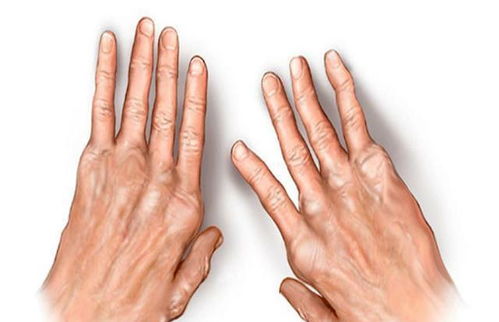 腿部風(fēng)濕注意事項