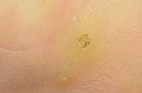 用尋常疣的藥膏有什么注意事項(xiàng)