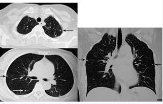 肺部纖維灶注意事項(xiàng)