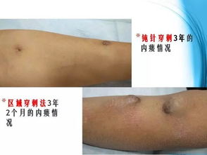 注意事項,血透拔針