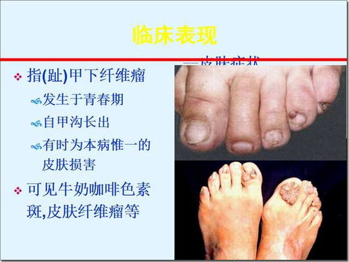 結(jié)節(jié)性硬化癥注意事項