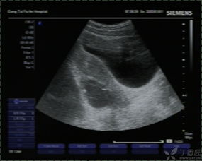 婦科做b超必須空腹嗎超注意事項(xiàng)