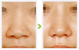 鼻孔,縮小,注意事項(xiàng),手術(shù)