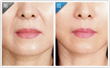 鼻唇溝填充物注意事項(xiàng)