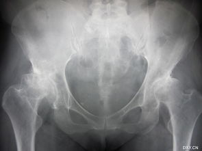 術(shù)后,置換,關(guān)節(jié),注意事項