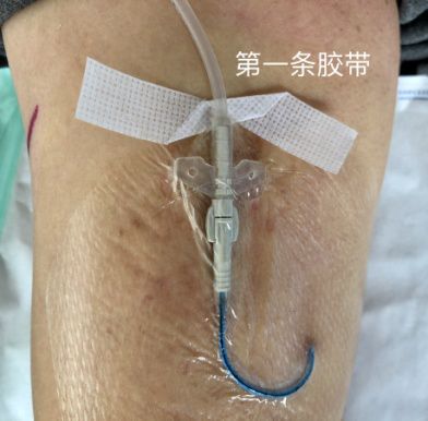 picc更換貼膜注意事項,cvc敷貼更換注意事項,picc敷料更換注意事項