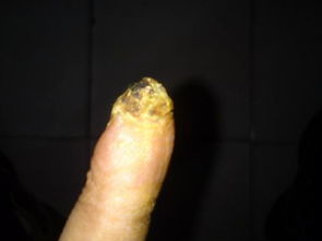 手指割傷飲食注意事項