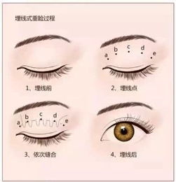 埋線拆線后需注意事項