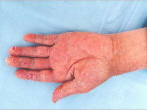 注意事項(xiàng),癬菌疹