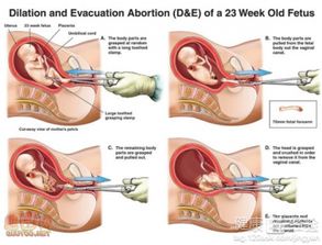 刮宮,無(wú)痛,注意事項(xiàng)