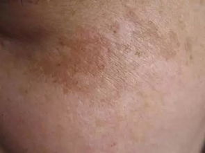 長(zhǎng)痘痘洗臉怎么注意事項(xiàng)