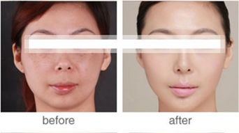 愛問,新浪,祛斑,激光