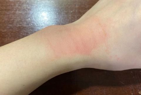 貼膏藥有哪些注意事項(xiàng)