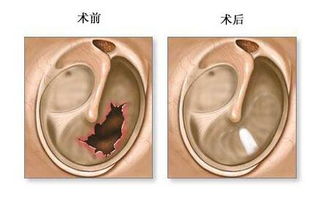耳膜,修補(bǔ),手術(shù)后,注意事項(xiàng)