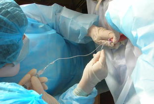 cvc置管拔出注意事項(xiàng)