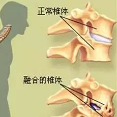 關(guān)節(jié)炎,脊柱,注意事項(xiàng)