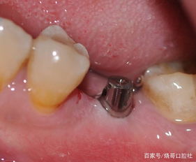 牙植骨要注意事項(xiàng)