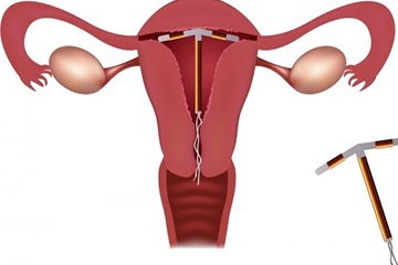 上環(huán),門診,術(shù)前,注意事項(xiàng)