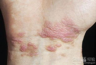 足蘚注意事項(xiàng),腳蘚注意事項(xiàng),花斑癬注意事項(xiàng)