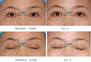 眼睛動(dòng)手術(shù)注意事項(xiàng)