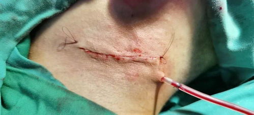 鰓裂囊腫術后注意事項,前庭大腺囊腫術后注意事項,會厭囊腫術后注意事項