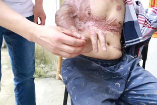 瘢痕攣縮注意事項